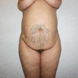 Abdominoplasty Before & After Patient #2096