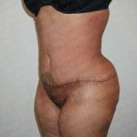 Abdominoplasty Before & After Patient #2096