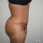 Abdominoplasty Before & After Patient #2096