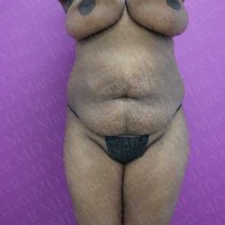 Abdominoplasty Before & After Patient #2095