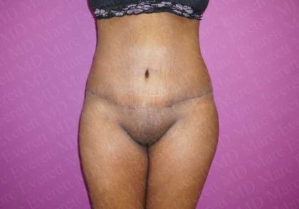 Abdominoplasty Before & After Patient #2095