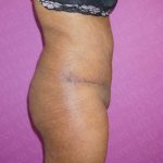 Abdominoplasty Before & After Patient #2095