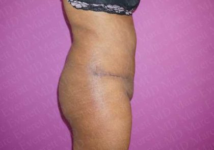 Abdominoplasty Before & After Patient #2095