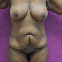 Body Lift Before & After Patient #1982