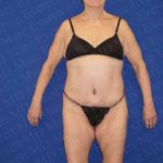 Body Lift Before & After Patient #1984