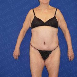Body Lift Before & After Patient #1984