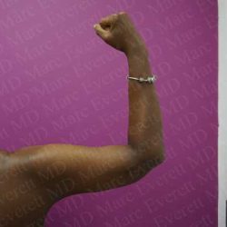 Brachioplasty Before & After Patient #1991