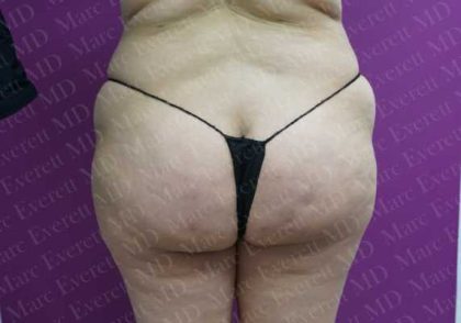 Brazilian Butt Lift (Fat Transfer to the Buttocks) Before & After Patient #2013