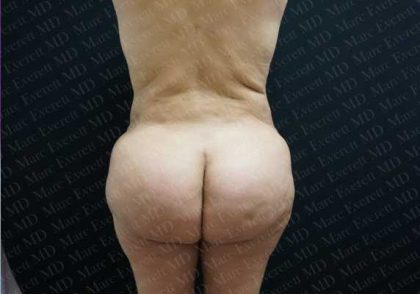 Brazilian Butt Lift (Fat Transfer to the Buttocks) Before & After Patient #2013