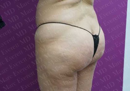 Brazilian Butt Lift (Fat Transfer to the Buttocks) Before & After Patient #2013