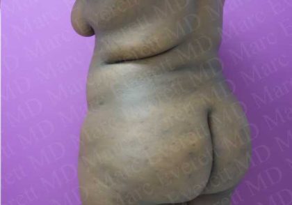 Brazilian Butt Lift (Fat Transfer to the Buttocks) Before & After Patient #2012