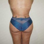 Brazilian Butt Lift (Fat Transfer to the Buttocks) Before & After Patient #2022