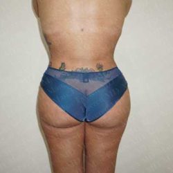 Brazilian Butt Lift (Fat Transfer to the Buttocks) Before & After Patient #2022