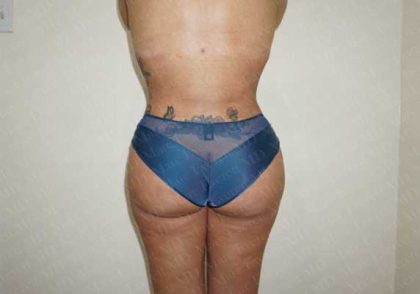 Fat Grafting Of The Buttocks Before & After Patient #2022