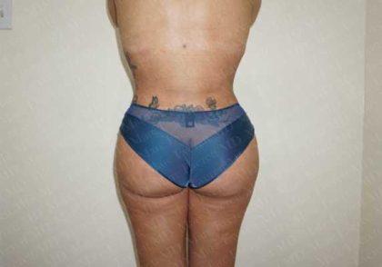 Brazilian Butt Lift (Fat Transfer to the Buttocks) Before & After Patient #2022