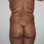 Brazilian Butt Lift (Fat Transfer to the Buttocks) Before & After Patient #2021