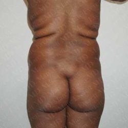 Brazilian Butt Lift (Fat Transfer to the Buttocks) Before & After Patient #2021