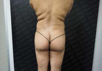 Brazilian Butt Lift (Fat Transfer to the Buttocks) Before & After Patient #2020