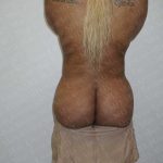 Brazilian Butt Lift (Fat Transfer to the Buttocks) Before & After Patient #2020