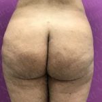 Brazilian Butt Lift (Fat Transfer to the Buttocks) Before & After Patient #2018