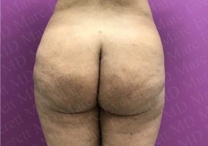 Brazilian Butt Lift (Fat Transfer to the Buttocks) Before & After Patient #2018