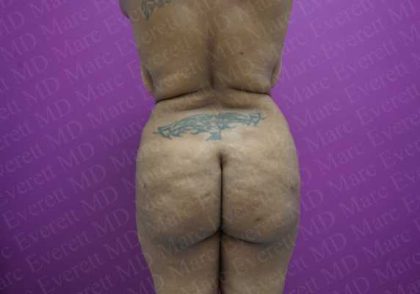 Brazilian Butt Lift (Fat Transfer to the Buttocks) Before & After Patient #2017