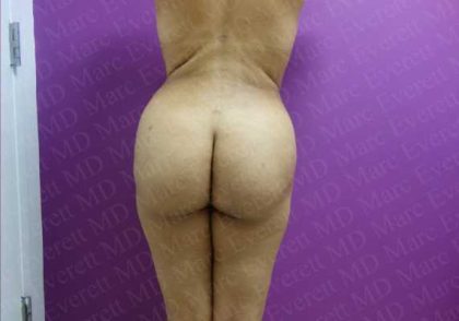 Brazilian Butt Lift (Fat Transfer to the Buttocks) Before & After Patient #2016