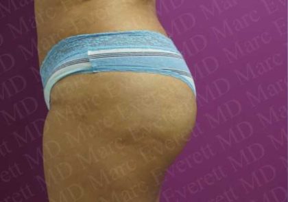 Brazilian Butt Lift (Fat Transfer to the Buttocks) Before & After Patient #2016