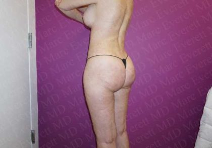 Brazilian Butt Lift (Fat Transfer to the Buttocks) Before & After Patient #2015