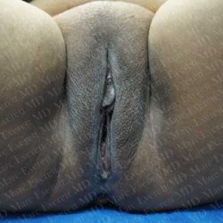 Labiaplasty Before & After Patient #2003
