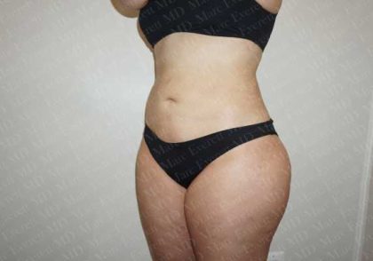 Liposuction Before & After Patient #2044
