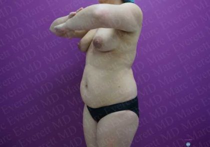 Liposuction Before & After Patient #2041