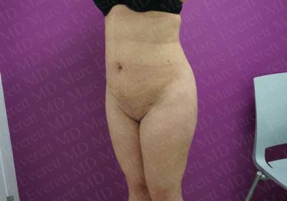 Liposuction Before & After Patient #2041