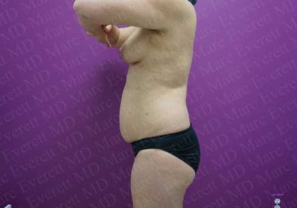 Liposuction Before & After Patient #2041