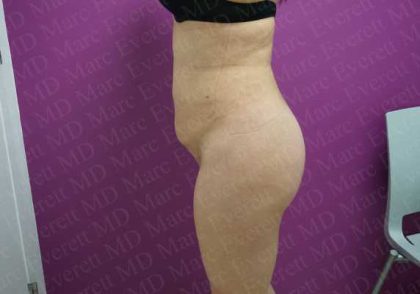 Liposuction Before & After Patient #2041