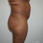 Liposuction Before & After Patient #2039
