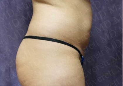 Liposuction Before & After Patient #2038