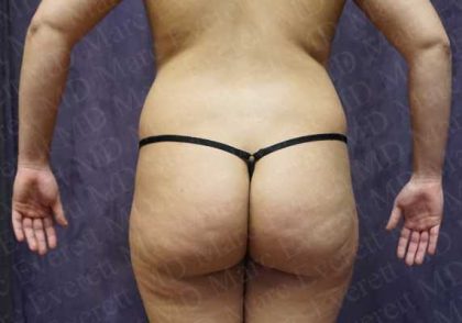 Liposuction Before & After Patient #2038