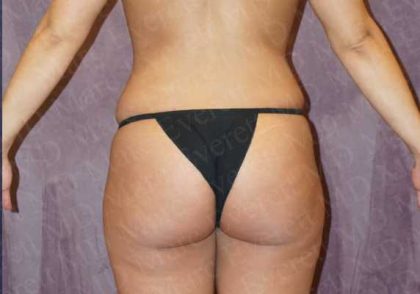 Liposuction Before & After Patient #2038
