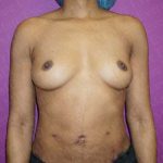 Breast Augmentation Before & After Patient #1924