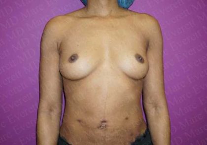 Breast Augmentation Before & After Patient #1924