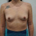 Breast Augmentation Before & After Patient #1895