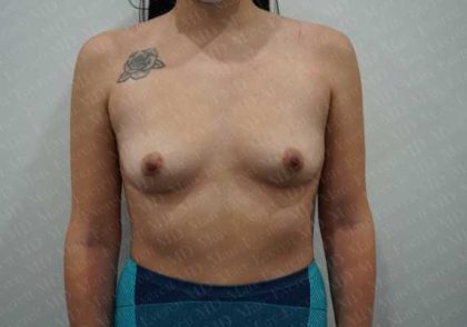 Breast Augmentation Before & After Patient #1895