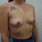 Breast Augmentation Before & After Patient #1895