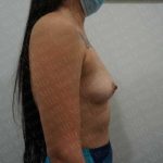 Breast Augmentation Before & After Patient #1895