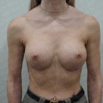 Breast Augmentation Before & After Patient #1867