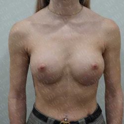 Breast Augmentation Before & After Patient #1867
