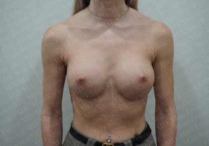 Breast Augmentation Before & After Patient #1867