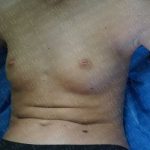Breast Augmentation Before & After Patient #1867