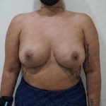 Breast Augmentation Before & After Patient #1866